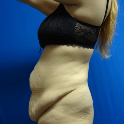 Manhattan abdominoplasty before 10